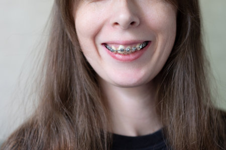 Woman's smile with dental braces to correct an overbite close-up. Correcting crooked teeth with iron bracesの写真素材