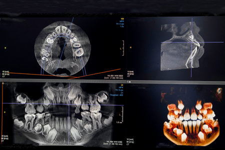 CT image of the teeth of a 9-year-old child, with baby teeth, in different projections. CBCT of two...