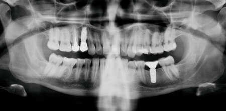Dental X-Ray teeth with implants. Black and white