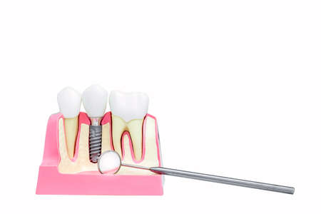 Implantology. Dental implants and human jaw model with dental mirror isolated on white background.