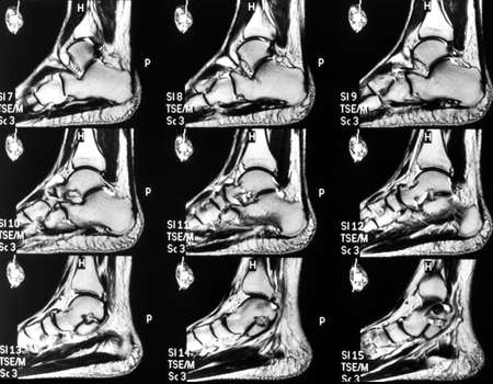 MRI Magnetic Resonance scan image of the left foot and ankle.の写真素材