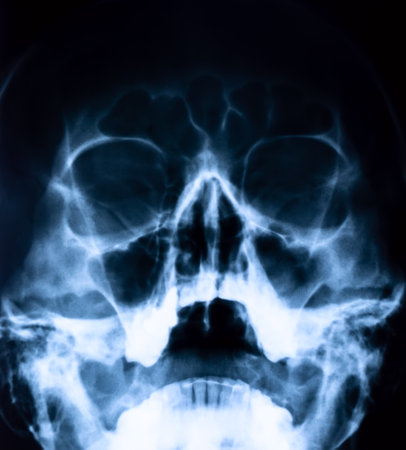 Medical concept. X-ray of nasal sinuses and head.の写真素材
