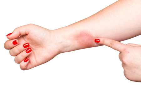 Woman showing strong fire burn on hand skin with red nails isolated on white backgroundの写真素材