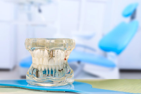 Dental Implantology. Human jaw model showing implants and cavities against dental chair in medical...