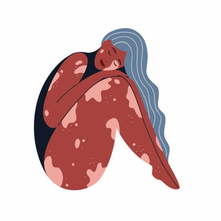 Beautiful woman with vitiligo. Concept to support people with vitiligo. vector illustrationのイラスト素材