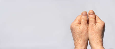 Nail fungus on the hands - dermatomicosis and onyhomicosis, comparison of healthy and sick nails. Dermatology, treatment of mycosis and skin infections. Banner copy space for textの写真素材