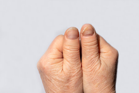 Fungus of nails - dermatomycosis and onychomycosis, fungal infection macro photo.