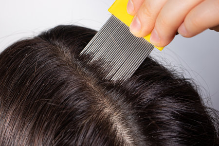 A brunette woman with pediculosis cleans her hair from lice and nits with a comb with small prongs. A lice combの写真素材