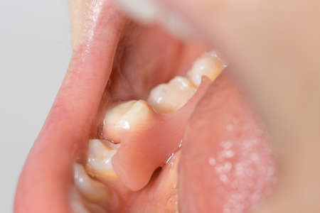 Artificial tooth removable prosthesis in the patient's mouth. Inserted a solitary fake molar in...
