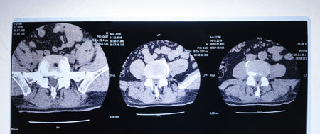 MRI image of the spine of a patient with scoliosis and protrusion of the intervertebral disc.の写真素材