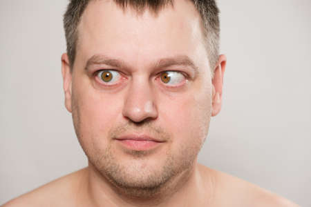 A man with strabismus squints his eyes on a white background