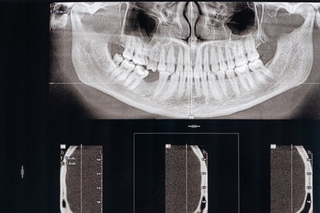 CT scan of a patient with missing chewing tooth and malocclusion