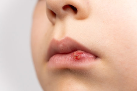 Skin damage, wound, abrasion on the lip of a small child.の写真素材
