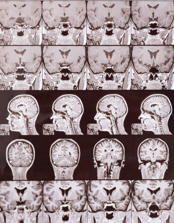 Magnetic resonance imaging of the head of a healthy person, image of the pituitary glandの写真素材
