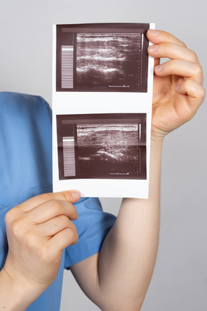 The doctor holds the results of an ultrasound of the thyroid gland of a patient with small nodules in the thyroid glandの写真素材