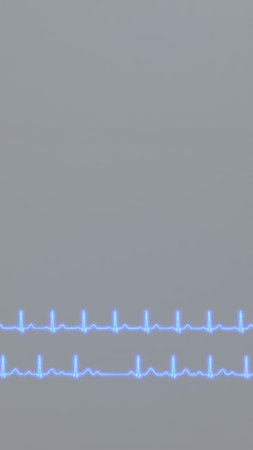 Comparison of ECG of normal heart rhythm and AV block 2nd degree
