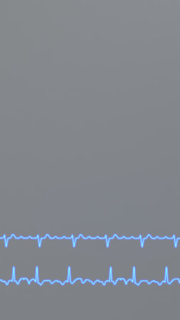 ECG graphs of regular and irregular atrial flutter.