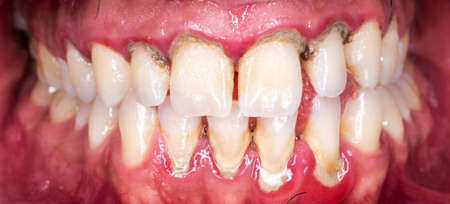 teeth tartar and calculus cleaning