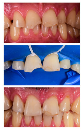 esthetic dental composite restorationの写真素材
