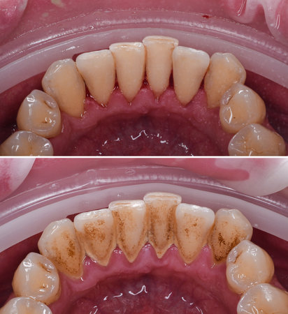 teeth tartar and calculus deep cleaningの写真素材
