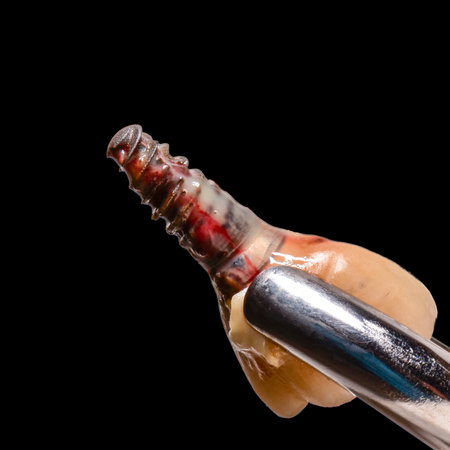 extracted dental implantの写真素材