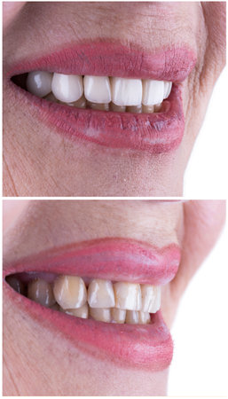 before and after picture of ceramic restorations on teeth by emax and zirkon crowns and veneersの写真素材