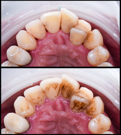 teeth tartar and calculus deep cleaningの写真素材
