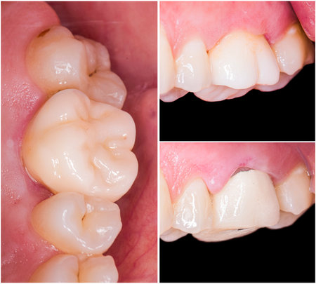 before and after picture of ceramic restorations on teeth by emax and zirkon crowns and veneers