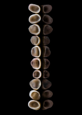 emax ceramic crowns and veneersの写真素材