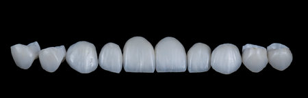 emax ceramic crowns and veneers