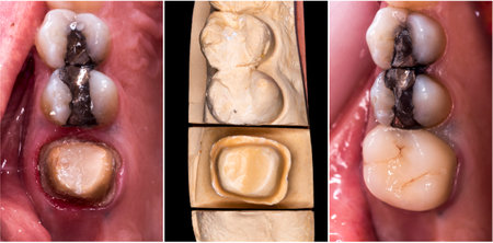 before and after picture of ceramic restorations on teeth by emax and zirkon crowns and veneers