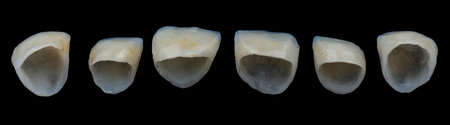 emax ceramic crowns and veneers