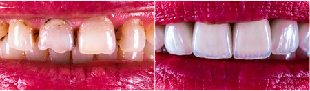 before and after picture of ceramic restorations on teeth by emax and zirkon crowns and veneers