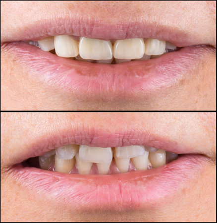 before and after picture of ceramic restorations on teeth by emax and zirkon crowns and veneersの写真素材