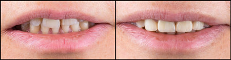before and after picture of ceramic restorations on teeth by emax and zirkon crowns and veneers