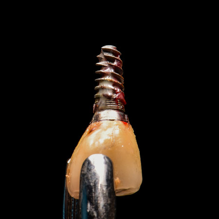extracted dental implantの写真素材