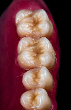high end dental denture with natural look ceramic teeth