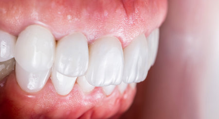 emax ceramic crowns and veneers