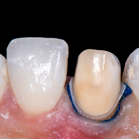 microscopic teeth preparation for emax crowns and veneersの写真素材