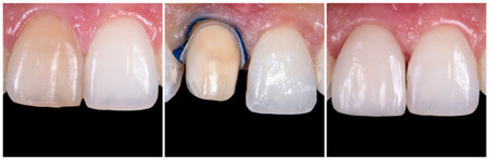 before and after picture of ceramic restorations on teeth by emax and zirkon crowns and veneers