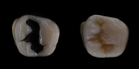 cavity treatment by direct composite restorationの写真素材
