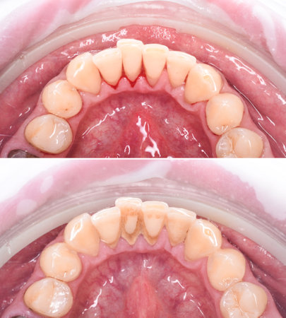 teeth tartar and calculus deep cleaningの写真素材