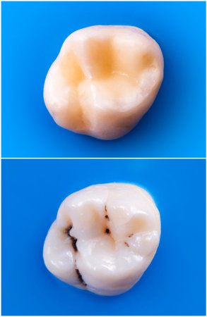 teeth direct fillingの写真素材