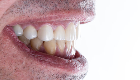 emax ceramic crowns and veneers