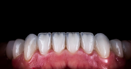 emax ceramic crowns and veneersの写真素材