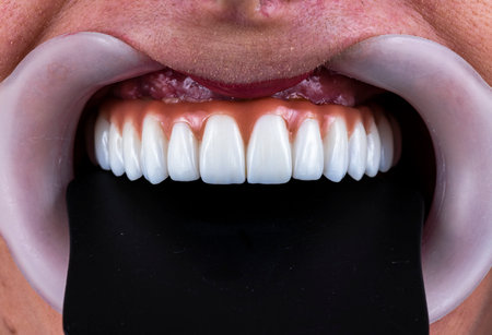 emax ceramic crowns and veneers