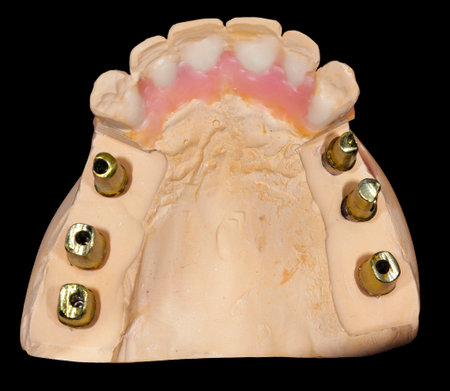 emax ceramic crowns and veneers