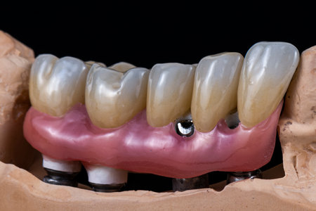emax ceramic crowns and veneers