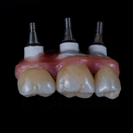 emax ceramic crowns and veneers