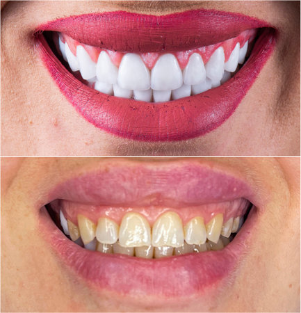emax ceramic crowns and veneers